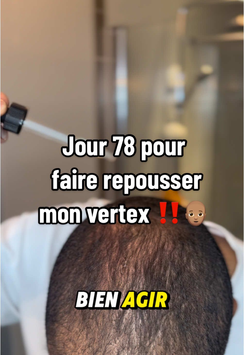 J+78 ou j’essaie de faire repousser mes cheveux ( calvitie) ‼️ #pourtoi #fyp #foryou #hairgrowthjourney #alopecieandrogenetique #calvitie #dermastamp #dermaroller #elixirderepousse #notevia #shampoingfortifiantgingembre #shampoingsolide #