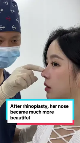Rhinoplasty Malaysia 🇲🇾 . . . . After rhinoplasty, her nose became much more beautiful#cosmeticsurgery #fypage #rhinopiasty #kualalumpur #malaysia #titkokmaidinh🔥 #dryangkim 