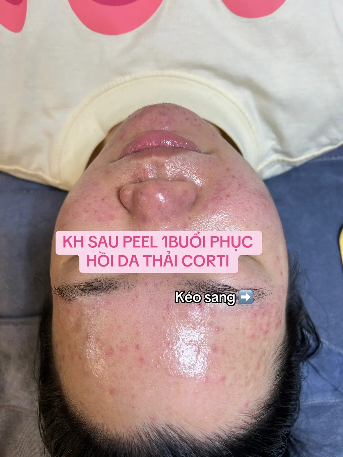 #mayspa #trị_mụn_chuẩn_ykhoa #peel_thải_độc_corticoid 