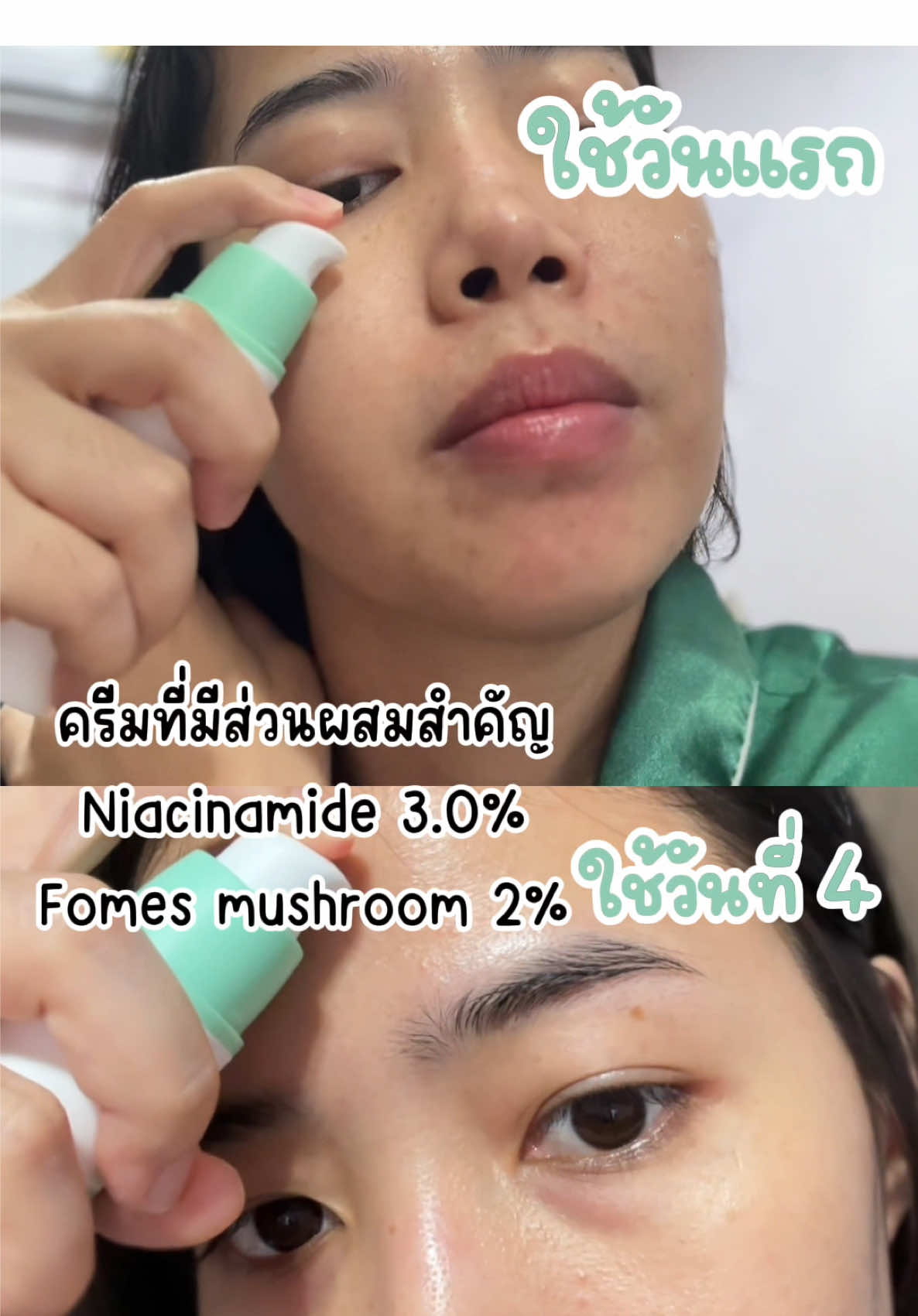 ปัญหารูขุมขนกว้าง รอยดำรอยแดงจากสิว #verite #vérité #acnecream #เวอริเต้ #veritethailand #skincare #moisturizer 