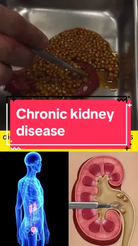 Chronic kidney disease #man #chronicillness #herbs #foryou #kidneyasthenia #healthytea #detoxkidney 