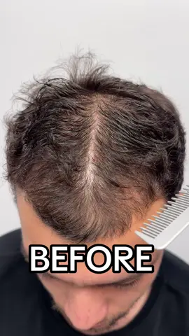 Male Pattern Hair Loss, Androgenic Alopecia 6 months into treatment #hairlosssolutions #hairlossremedy #hairlossjourney #hairlosstreatment #hairlosshelp #hairlosstips #hairlosssolution #prp #prpackage #prphairrestoration #minoxidil #minoxidilresult 