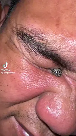 #pimplepop #pimple #blackhead #pimpleremover #pimpleaddiction #pimplepopper2024 #Bigpimplepoping #satisfyingvideo 