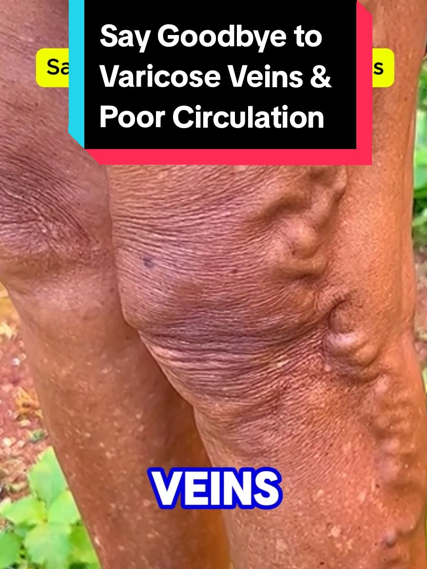 Say goodbye to varicose veins and poor circulation with this simple yet powerful home remedy. #varicoseveins #varicoseveinstreatment #bloodcirculation #varicoseveinremoval #varicoseremover  #varicose #veins #Recipe  Say Goodbye to Varicose Veins Naturally with this simple recipe. #naturalremedies #naturalremedy #recipes #remedy 