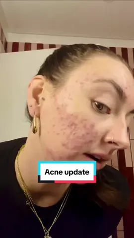 @Lexi Jenkinson has struggled with adult acne and just started her journey on our acne vitamin a month ago. She’s already seeing some good results so be sure to follow her to see her incredible journey 🙌 #acnebeforeandafter #acnejourney #skincaretips #pimples 