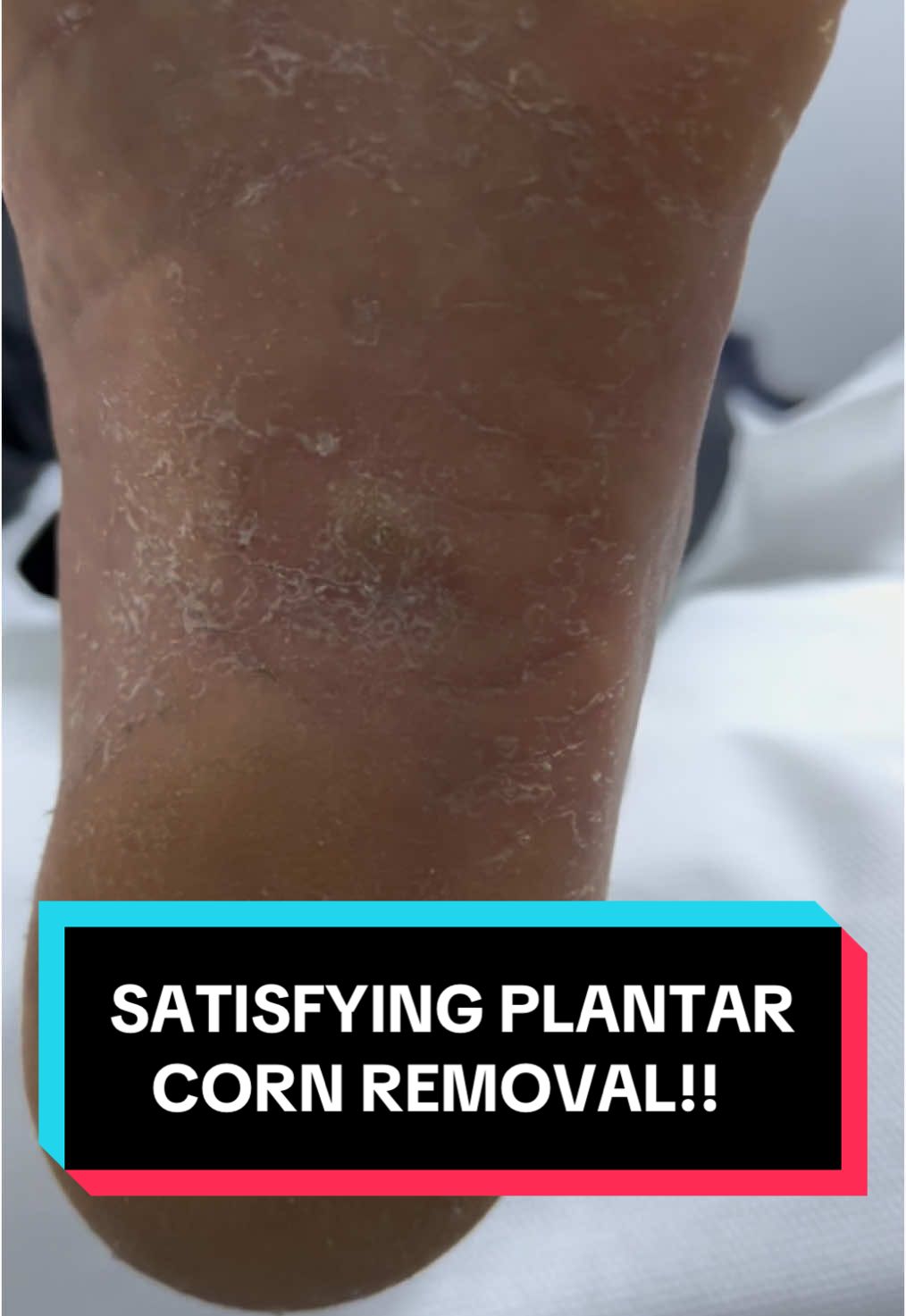 Another painful corn removal! #fyp #foryou #foryoupage #viral #podiatry #sydney #australia #corn #feet #foot #satisfying #wart #asmr #pimple #toes #nail #nails 