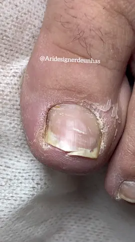 #manicure #pes #cutilagemperfeita #cutilagem #unhaencravada #unhadope #podologo #calosidade #ingrowntonail #tiktokmefazassistir #encravada #cuticula #viral #fypシ #cuticulagem #satisfatorioasmr #sextou #satisfatorio #podologia #tiktok @Vídeos de Unha Encravada @Unha Encravada 2024 @Cuide dos seus pés @encravadasunhas @unhaencravada 