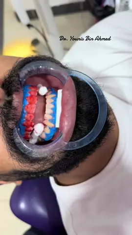 دامت ابتسامتكم مُضيئة🌒 حالة #تبييض_للأسنان🪄 #True & #natural Hollywood smile😍 ⚪️Material used 𝙈𝙖𝙙𝙚 𝙞𝙣 𝙂𝙚𝙧𝙢𝙖𝙣𝙮 🔥 •#BMS white 38% [3 sessions / 20 min each] •#BMS prophyx v polishing paste Thnx MD Dental🙏 #MD_DENTAL #bms_dental #bms_white #Bleaching #smile #E_s_t_i_c_n_a_n✨ #smilestrong #toothwitening #ابتسم_من_قلبك #ابتسامة_هوليود #ابتسامة_المشاهير🔥😍 @Handodyy @MD Dental 