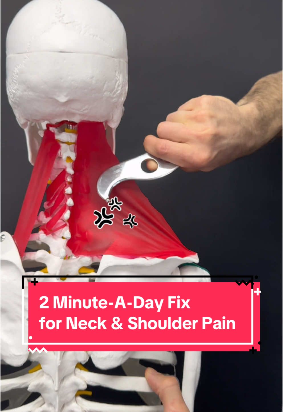 Do you experience, persistent, aching on the top of your shoulder into your neck? And you’ve tried a bunch of specific approaches seeing different practitioners but no relief? Well, this study showed that the solution could be a lot simpler than you think by just simply building and strength. And they found that in two minutes or less a day you could have significant reductions in pain by following this protocol. Effectiveness of small daily amounts of progressive resistance training for frequent neck/shoulder pain: randomised controlled trial Lars L Andersen et al. Pain. 2011 Feb. #neck #neckpain #neckpainrelief #shoulderpain #tmj #tmd 