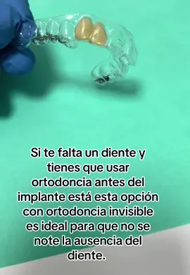 Si te falta un diente y tienes que usar ortodoncia antes del implante está esta opción con ortodoncia invisible es ideal para que no se note la ausencia del diente.  #ortodonciainvisible #prótesis #preparaciónpreprotésica #prótesisdental #ortodonciafija #ortodoncista #madrid #antesydespues #parati #foryuopage #pourtoii #españa #implantesdentarios #ortodonciaeimplantes 