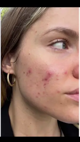 Skin healing journey #greenscreen #skinhealth #nutritionist #hormonehealth 