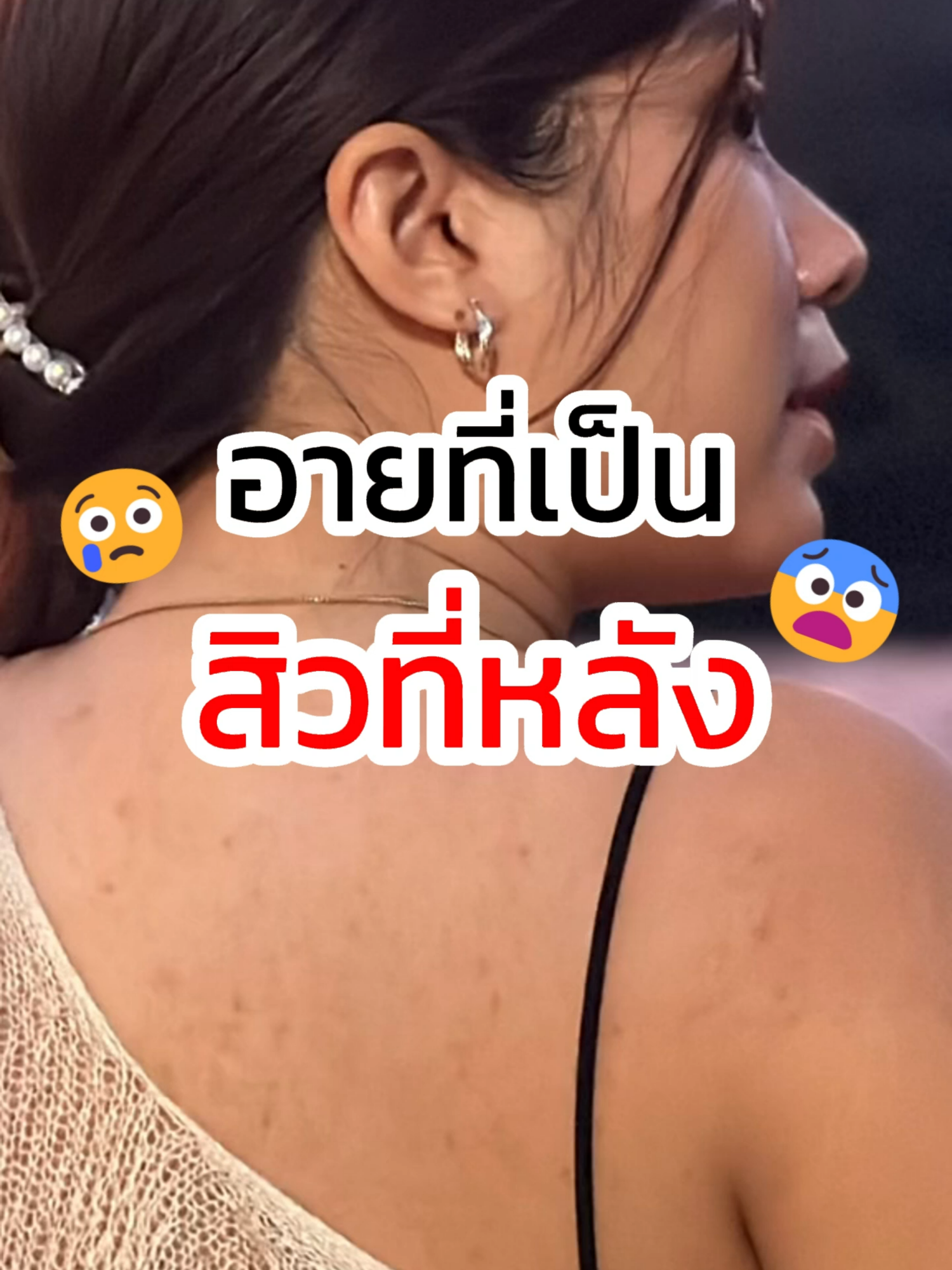 อายที่เป็นสิวที่หลัง ไม่หายซักที😨 #สเปรย์สิวหลังเพียวรี ช่วยได้ เพิ่มความมั่นใจกล้ากลับมาใส่เสื้อเปิดหลังอีกครั้ง ✨#peurri #เพียวรี #สิว #รักษาสิว #สิวหลัง #รีวิวบิวตี้ #tiktokป้ายยา