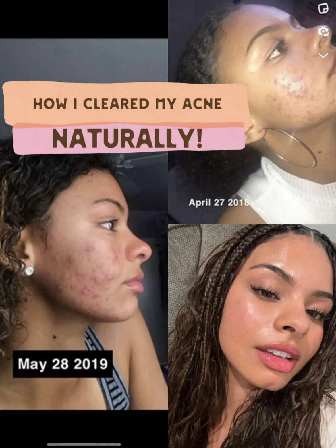 I hope these tips help!! This is just some of the main things I did to help my acne 🥰💃🍒 #​clearskin  #​acne  #​howtoclearacne #​clearskinroutine #​acnefighter #​acne treatment  #​acnetips#Lemon8 