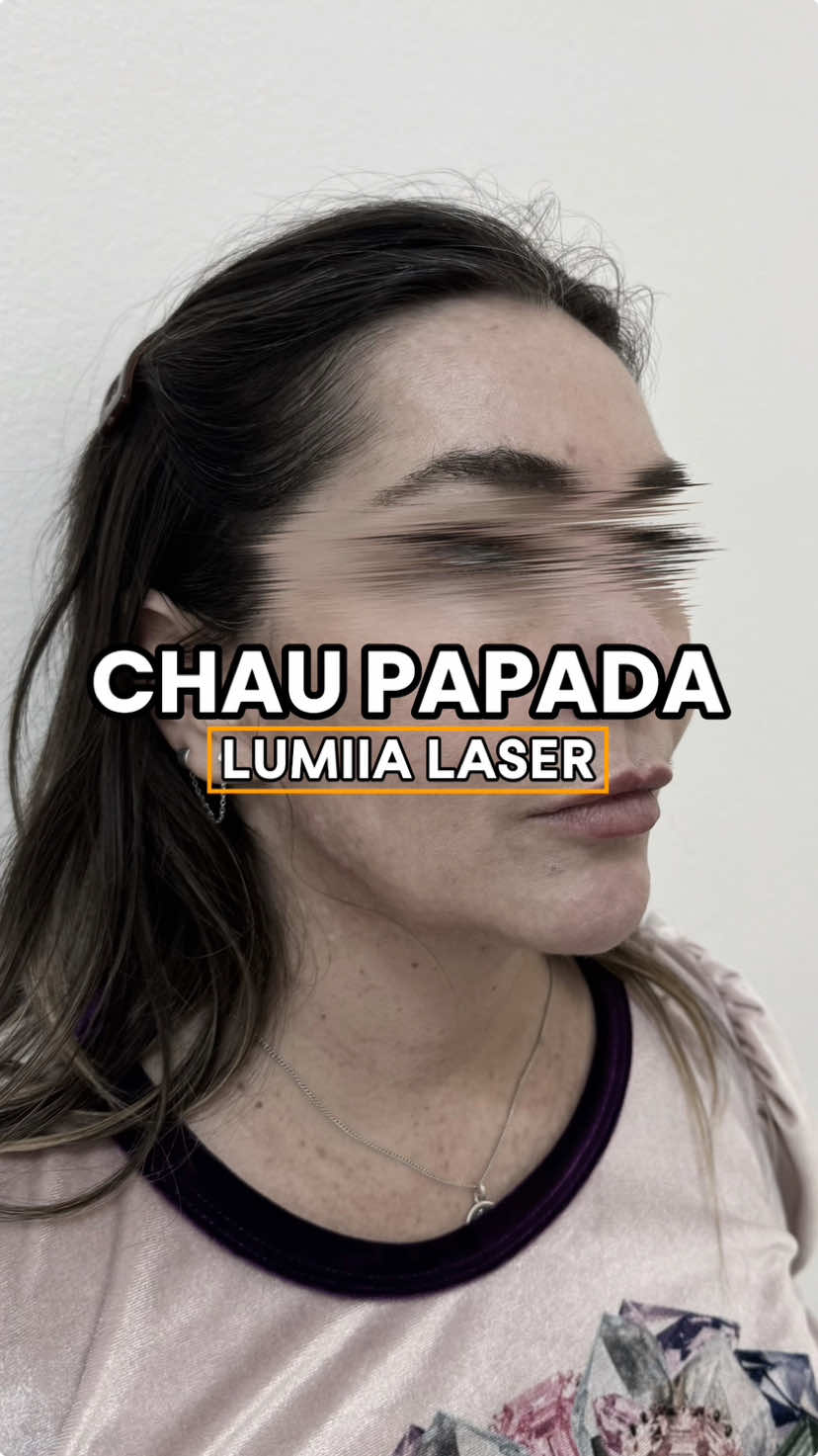 Chau papada con Lumiia Laser  #papada #antesydespues #lumiialaser 