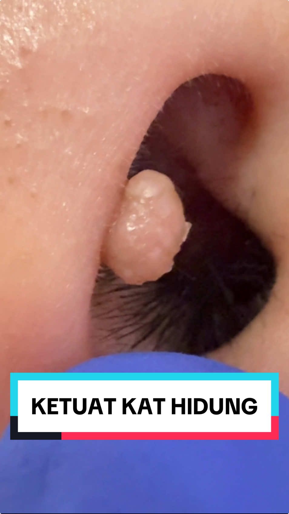 Laser Ketuat Viral Warts Kat Hidung