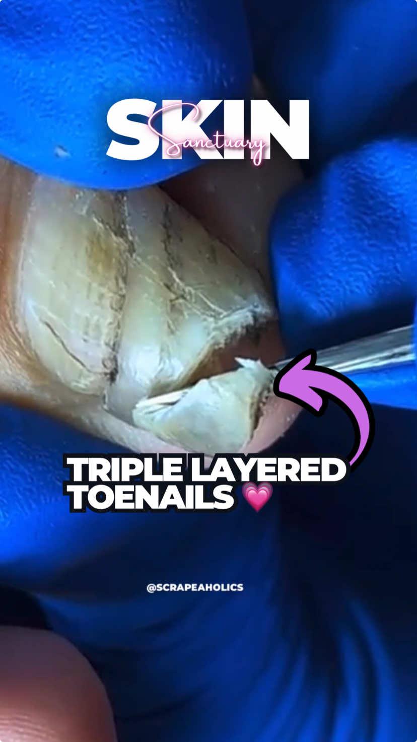 “When one toenail feels like three!” Triple-layered nails can be tricky, but they are no match when taken care of with the right tools and technique! 🥰 Hey there viewer, yes you 🫵🏼 while you’re here, please check out our TikTok shop page for a great deal on all Face, Feet, and Ear Care #toenail #toenails #thicktoenails #podiatry #foottok #scraoeaholics #toenailcare #skinsanctuary #LearnOnTikTok #satisfying #fyp #viral #trendingvideo