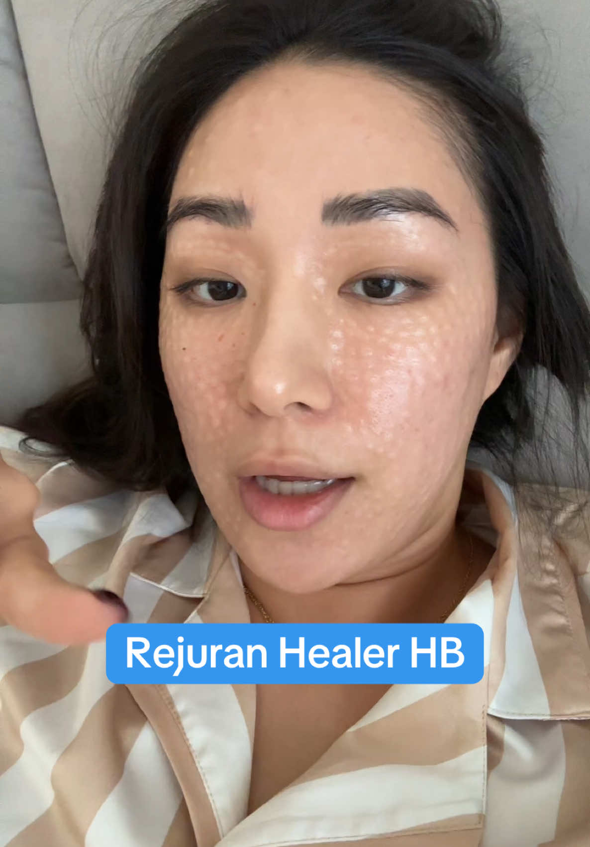 I was SO scared to do this fully awake but honestly it wasnt that bad! Definitely way better than what I had in mind! So excited to see the result!! #rejuranhealer #rejuranhealerhb #koreanclinic #korea #gangnam #beauty #skintreatment #skinbooster #glassskin #skinbarrier #hydration #recommendation 