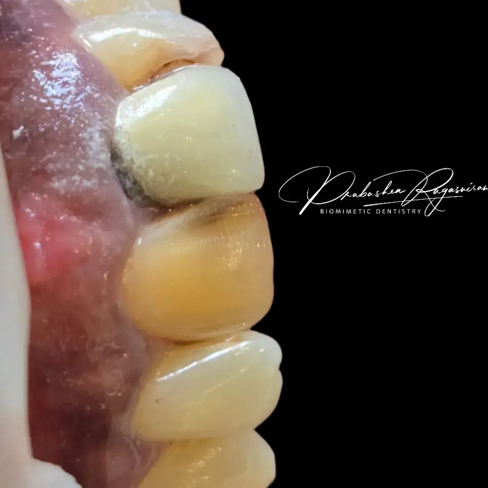 🎨 Transforming Smiles with Precision! 🦷✨ Today, we tackled a challenging case of masking non-vital teeth using biomimetic techniques to create natural, lifelike results. Here's the step-by-step process we followed: 1️⃣ Masking Non-Vital Teeth: Achieving seamless integration with natural dentition. 2️⃣ XBW G-aenial Base: Building a strong, aesthetic foundation. 3️⃣ Perfect Sealing: Using flowable composite near the band to ensure a tight seal. By pressing packable composite against it and curing them together, the flowable fills those tight spaces flawlessly. 4️⃣ Cleaning Up Details: Any flowable extrusion near the gingiva is wiped off with a microbrush before curing for a clean finish. 5️⃣ Incisal Edge Characterization: Adding natural blue and white tints for a truly lifelike appearance. The final restoration speaks for itself – a smile that's both functional and beautiful! 💎 📍 Biomimetic Dentistry at its finest. Let us design your perfect smile! #SmileMakeover  #BiomimeticDentistry  #NaturalRestorations  #DentalArtistry  #DentistryDoneRight  #SmileTransformation #DentistOnTikTok #BiomimeticDentistry #AestheticDentistry #DentalRestoration #HealthySmileJourney #BeforeAndAfterSmile #TikTokDentist #NaturalTeethRestoration #SmileGoals #DentistryTips #OralHealthMatters #CosmeticDentistry #TeethTransformation #PerfectSmile #SAMA28  #durbansouthafrica 