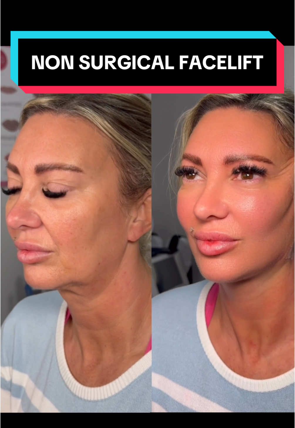 PDO Thread Facelift #pdothreads #pdothreadslondon #pdothreadsexpert #pdothreadstraining #facelift #nonsurgicalfacelift #antiageing #pdo #fy #fyp #viral_video 