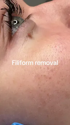 #filiform #wartsremoval #skintagremoval #squeezeyuk #mole #fyp 