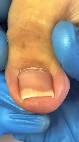 Pedicure #fypシ #fyp #foryou #ingrowntoenail #doctorming #viral #pedicure #everyone #trending 