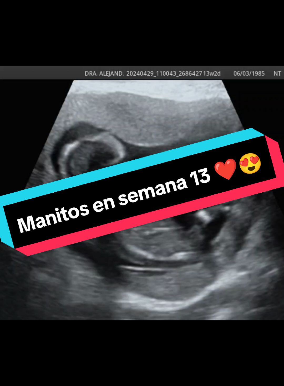 Aunque mide 7 cm podemos ver su estructura e incluso ver sus manos y dedos ❤️😍 #maternidad #semana13 #ginecologa #embarazo 