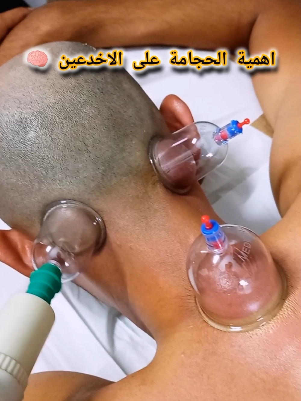 اهمية الحجامة على الأخدعين 🧠👏🏼#الحجامة_النبوية #الحجامة_شفاء #الحجامة_الطبية #حجامة_جافة #الحجامة #حجامة #cupping #الحجام #hijama #اكسبلور 