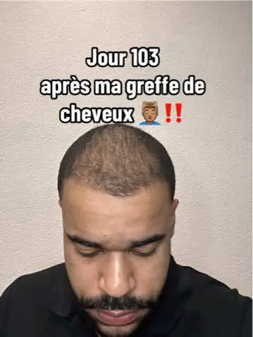 Désolé pour la qualité aujourd’hui, jai pas le bon téléphone #foryoupagе #pourtoi #fyp  #greffedecheveux #hairtransplant #hairgrowthjourney 