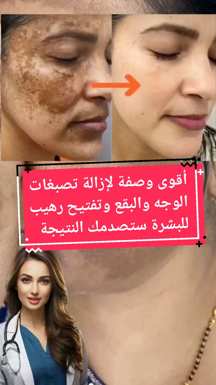 الوصفة المعجزة لتخلص نهائيا من التصبغات والكلف والبقع الداكنة ستصدمك النتيجة  #وصفة #وصفة_مجربة #وصفات_طبيعية #وصفات #وصفات_سهله #تصبغات_الوجه #تصبغات_البشره #تصبغات_الجلد #تصبغات_البشره_بقع #تصبغات_البشرة #تفتيح_البشرة #تفتيح_الجسم #تفتيح_فوري_للبشرة #تبييض_بشرة #تبييض_البشره #تبييض_الوجه #بشرة_صافية #بشرة_ناعمة #البشرة_الدهنية #france #explore #pourtoi #المغرب🇲🇦تونس🇹🇳الجزائر🇩🇿 #@dada_beauty_ma❤️ @dada_beauty_ma❤️ @dada_beauty_ma❤️ 