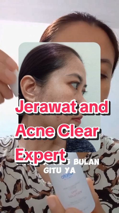 Jerawat akhirnya mulai kempes dan memudar. #acneclearexpertsystem #skincareatomy #skincarekorea 