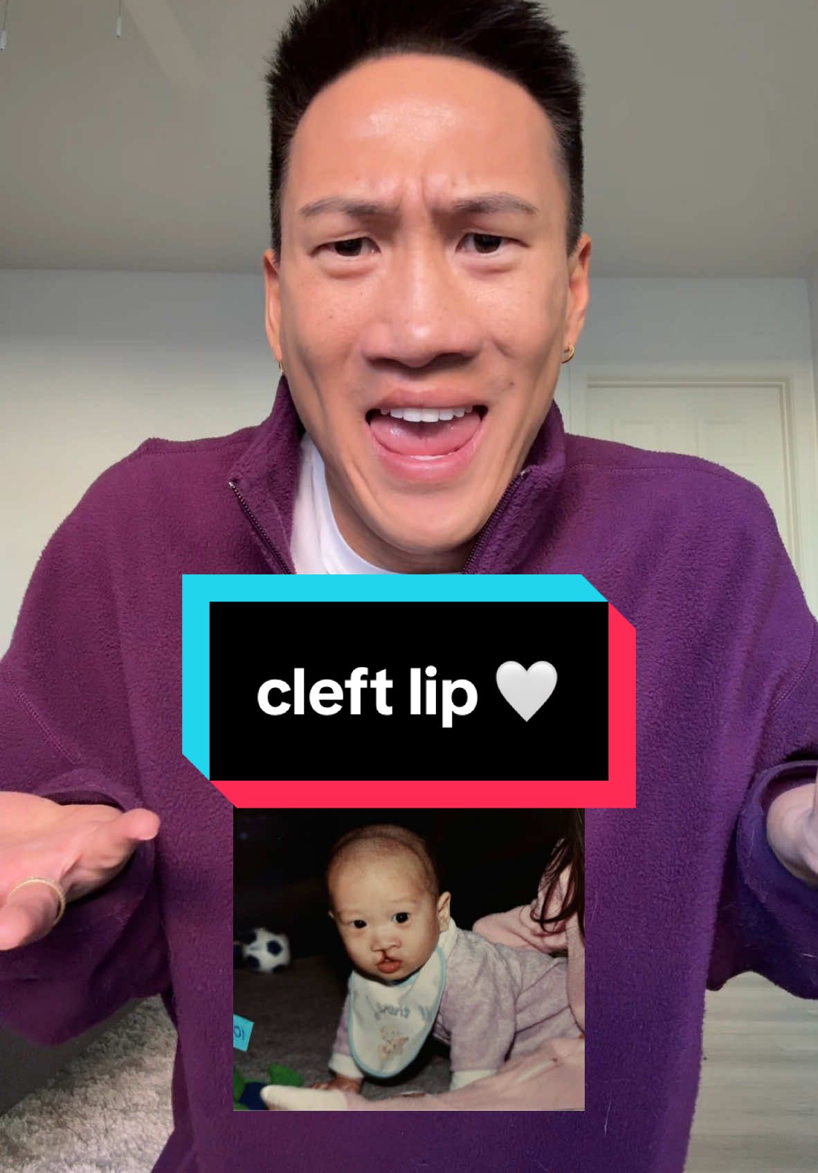 comment below your questions #cleftlip #cleftpalate #cleftawarness 