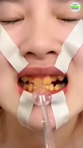 #lanbena #teethwhitening #yellowteeth #teethcare #teethcleaning 