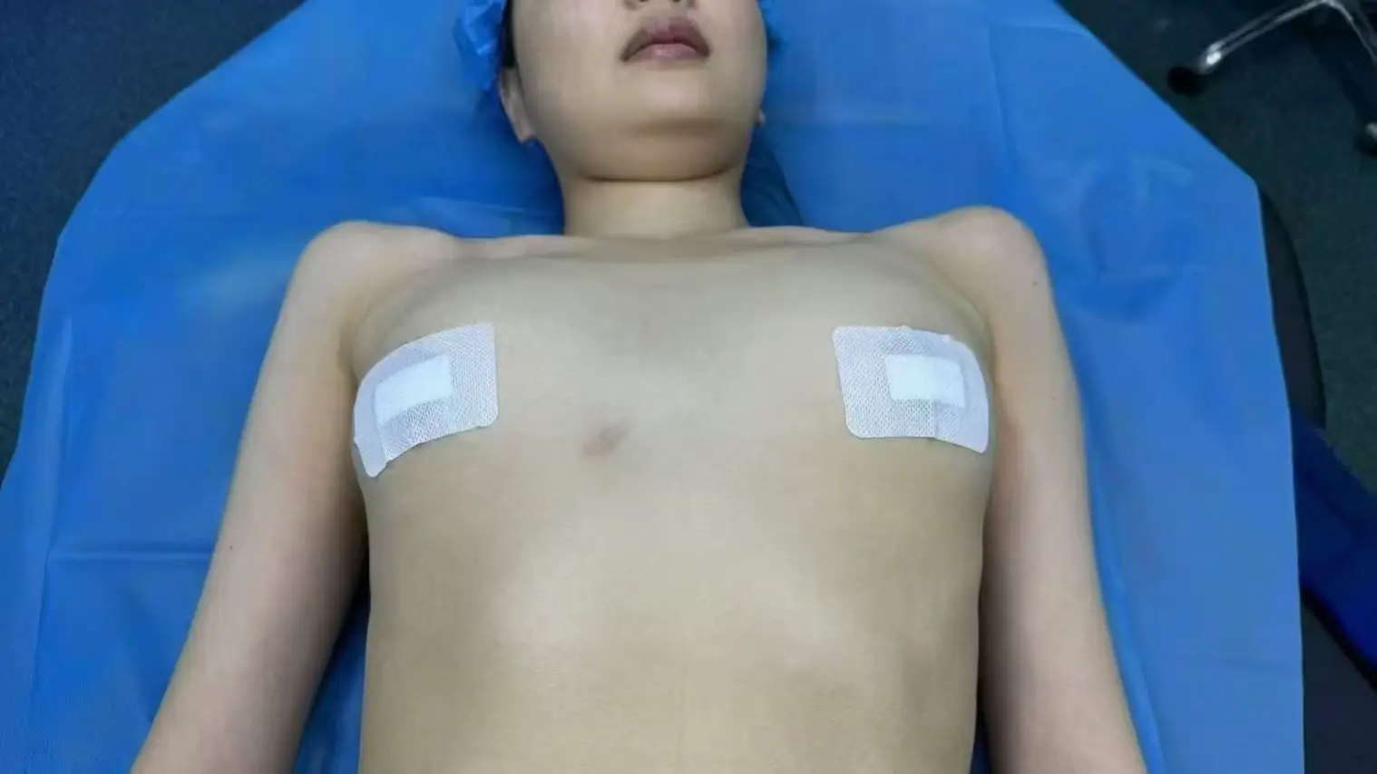 Breast augmentation surgery