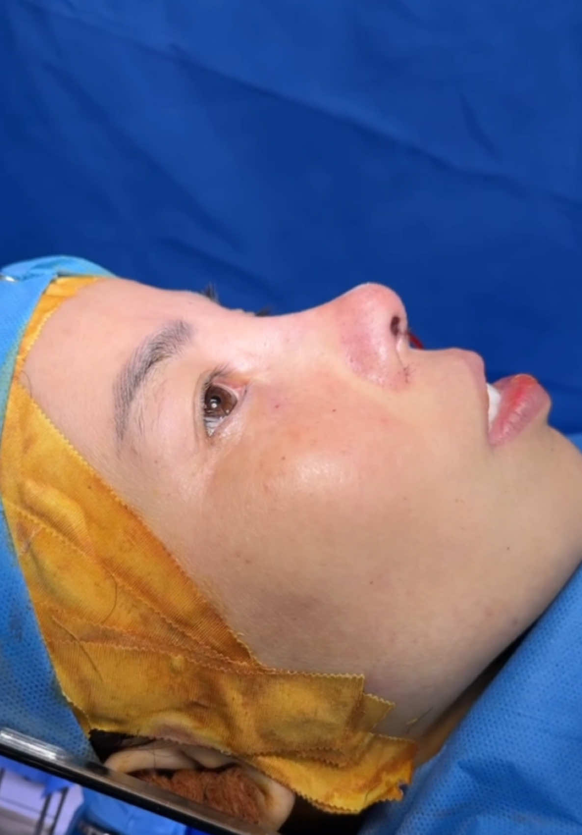 Cả nhà đánh giá bao nhiêu điểm cho ca giải cứu mũi hỏng này??? #drson #operasi #hidung #nose #indonesia #thailand #suamuihong #goclamdep 