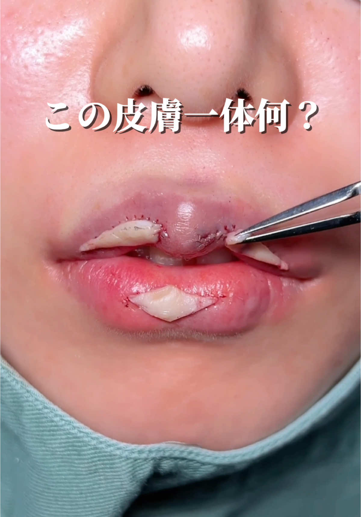 #唇整形 #唇 #整形 #M字リップ #lip #lipfiller 