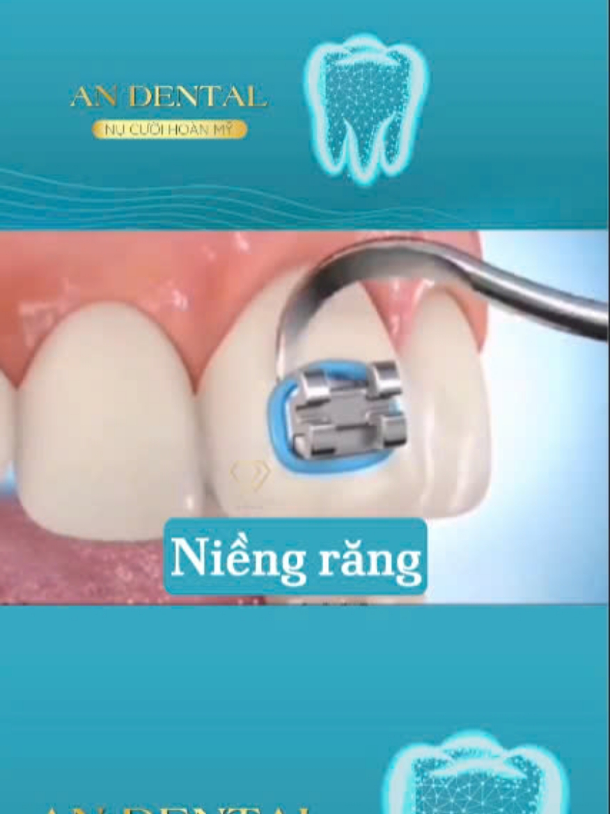 Niềng răng #nhakhoa #nhakhoaan #chamsocrangmieng #răng #chamsocrangmieng #xuhuong #niềng_răng #chamsocvalamdep 