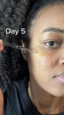In a week ? with the tone  brightening capsule ampoule from @SKIN1004 Official which has centella Asiatica that soothed & calmed my skin , improved it’s texture too🌸. #skin1004ampoule #tonebrightening #tonebrighteningcapsuleampoule #acnescars #hyperpigmentation #glassskin #glowyskin #koreanskincare #centellaasiatica #sherahnjeru #uniquebysherahbodyhaircare 