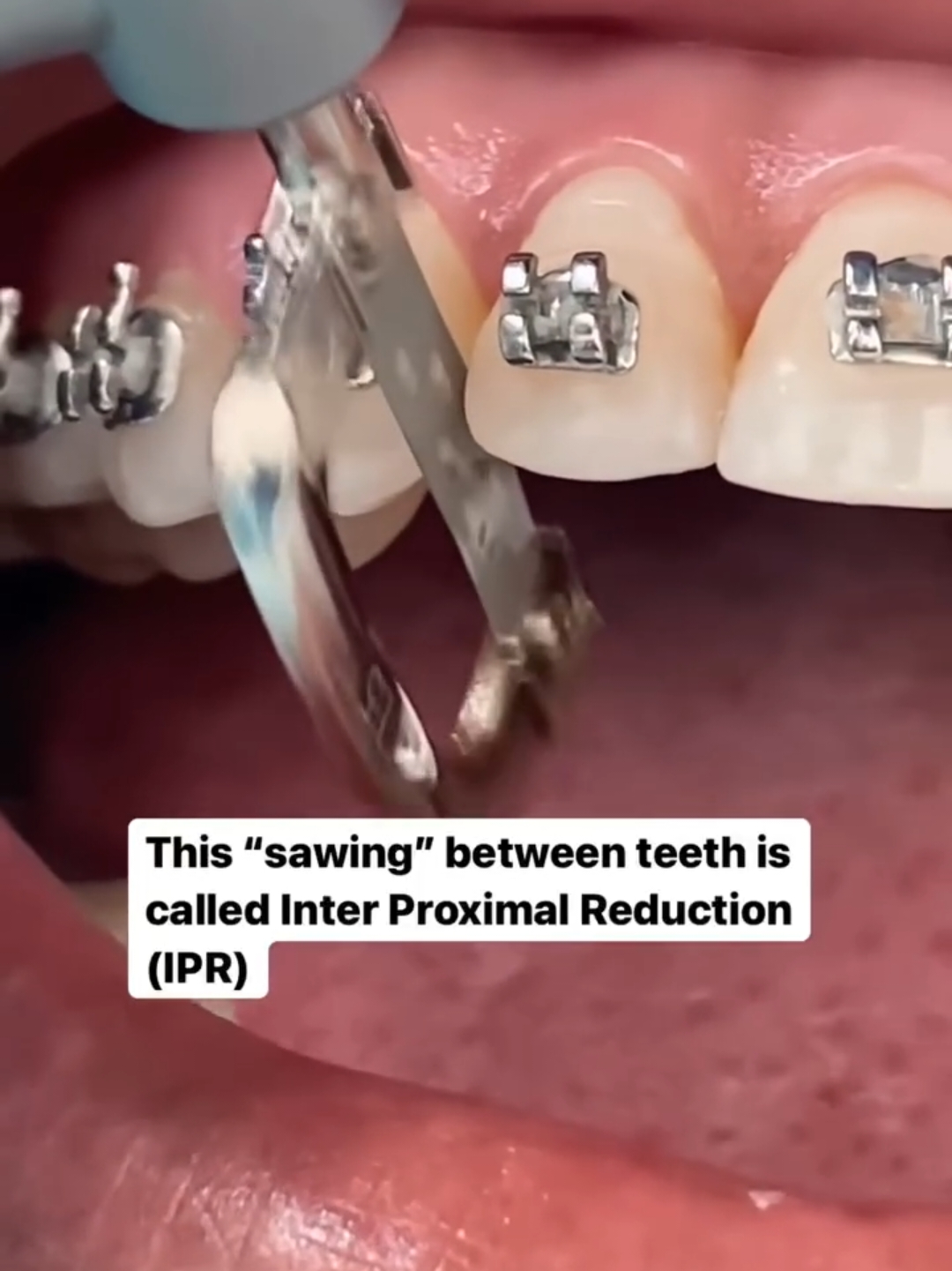 IPR #samerakkad #سامرعقاد  #orthodontist #orthodox #orthodontics   #تقويم #تقويم_الاسنان #تقويم_الرياض #تقويم_اسنان #تقويم_شفاف 