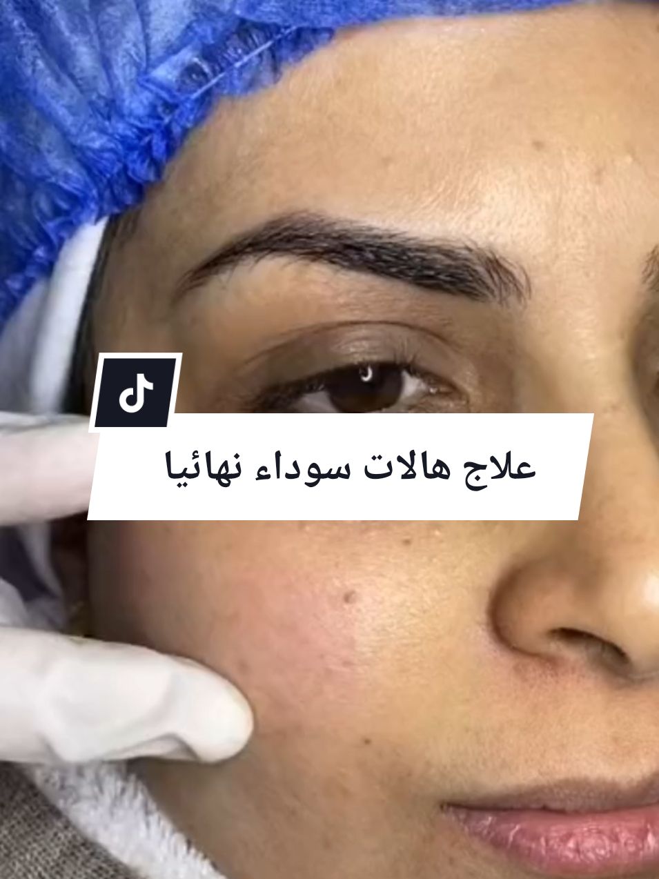 علاج الهالات سوداء نهائيا  علاج الهالات سوداء بسرعة #ازالة_الهالات_السوداء_بسرعة #خلطات #وصفة_سهلة #وصفة #وصفة_مجربة #المغرب🇲🇦تونس🇹🇳الجزائر🇩🇿 #المغرب #متابعة #dogsoftiktok #fouryourpage #tiktoknews #videoviral #captureramadanspark #capcut_edit #videoviral #edit #explore #pourtoi #pourtoii #creator #live##creatorsearchinsights#edit  #liveforthechallenge #viral_video #lik #اكسبلوررررر #@missdouaa @شيماء🖤🐆 @✨شيماء ضحيكة✨ 