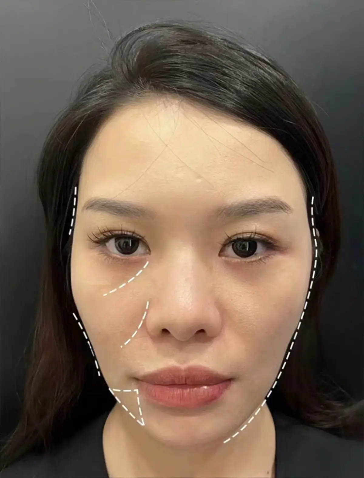 Thiết kế mặt @Lê trinh @Lê Trinh Đào Tạo Học Viên 2 #FillerBotox #căngchi #botox #aisilips #aisilips #LearnOnTikTok #karasmai #giảmmỡbụng #plla #mdcodes #căngchi #thietke #taọhinh 