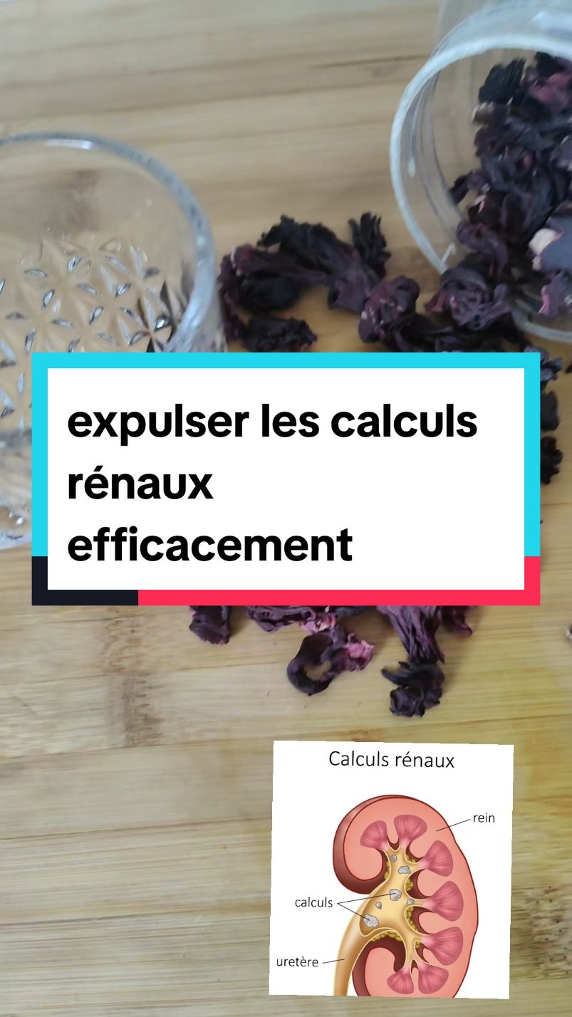 Remèdes Naturels pour Expulser les Calculs Rénaux Efficacement #الشعب_الصيني_ماله_حل😂😂 #remedenaturel #fouryoupage_tiktok_ #pourtoipage #frypgシ #viralvideo #f #fry 