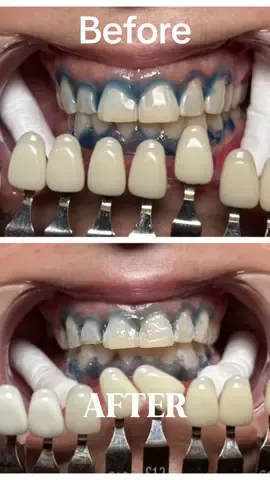 Look at how much this beauty’s teeth decreased after her very first 30 minute teeth whitening session with @radiant_aesthetics2! From the comfort of your own home, book now for your mobile teeth whitening treatment at https://radiantaesthetics2.glossgenius.com  #teeth #whitening #creatorsearchinsights #teethtok #trend #SmallBusiness #smallbusinessowner #fyp #smallbusinesstiktok #smallbusinesscheck #teethwhitening #30 #30minutes #CapCut 
