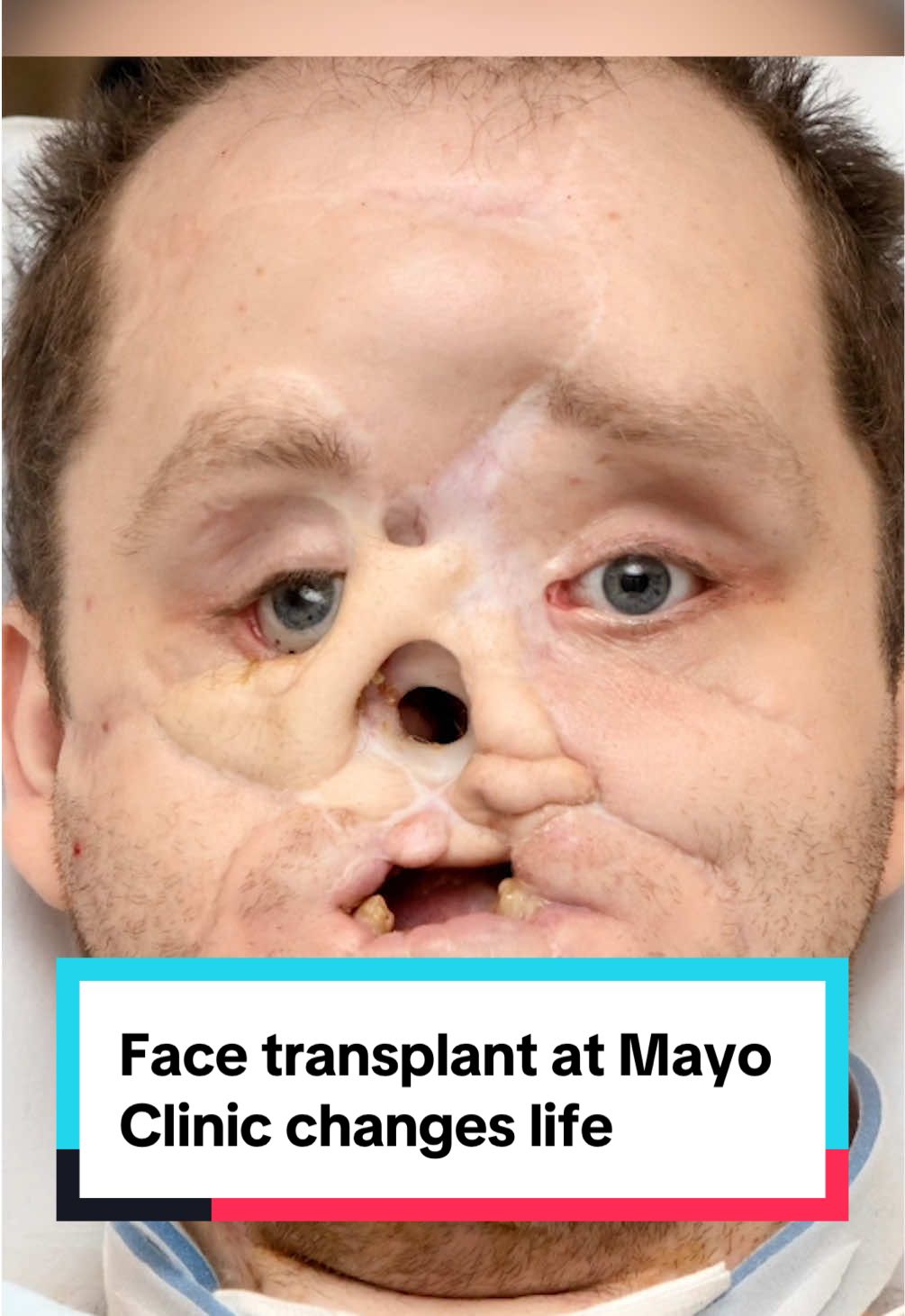 Face transplant at Mayo Clinic transforms Michigan man's life. Nearly a decade after he shot himself in a failed suicide attempt, Derek Pfaff underwent a 50-hour face transplant, restoring his ability to eat and breathe normally. Tap the link in our bio to learn more.