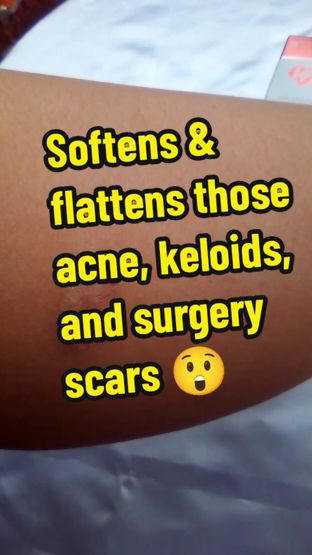 I was super excited to find a product that is the number one dermatologist and plastic surgeon recommended. I have been looking for an effective keloid and surgery scar product. Stay tuned as I show the results in 30 days. @HealFast 