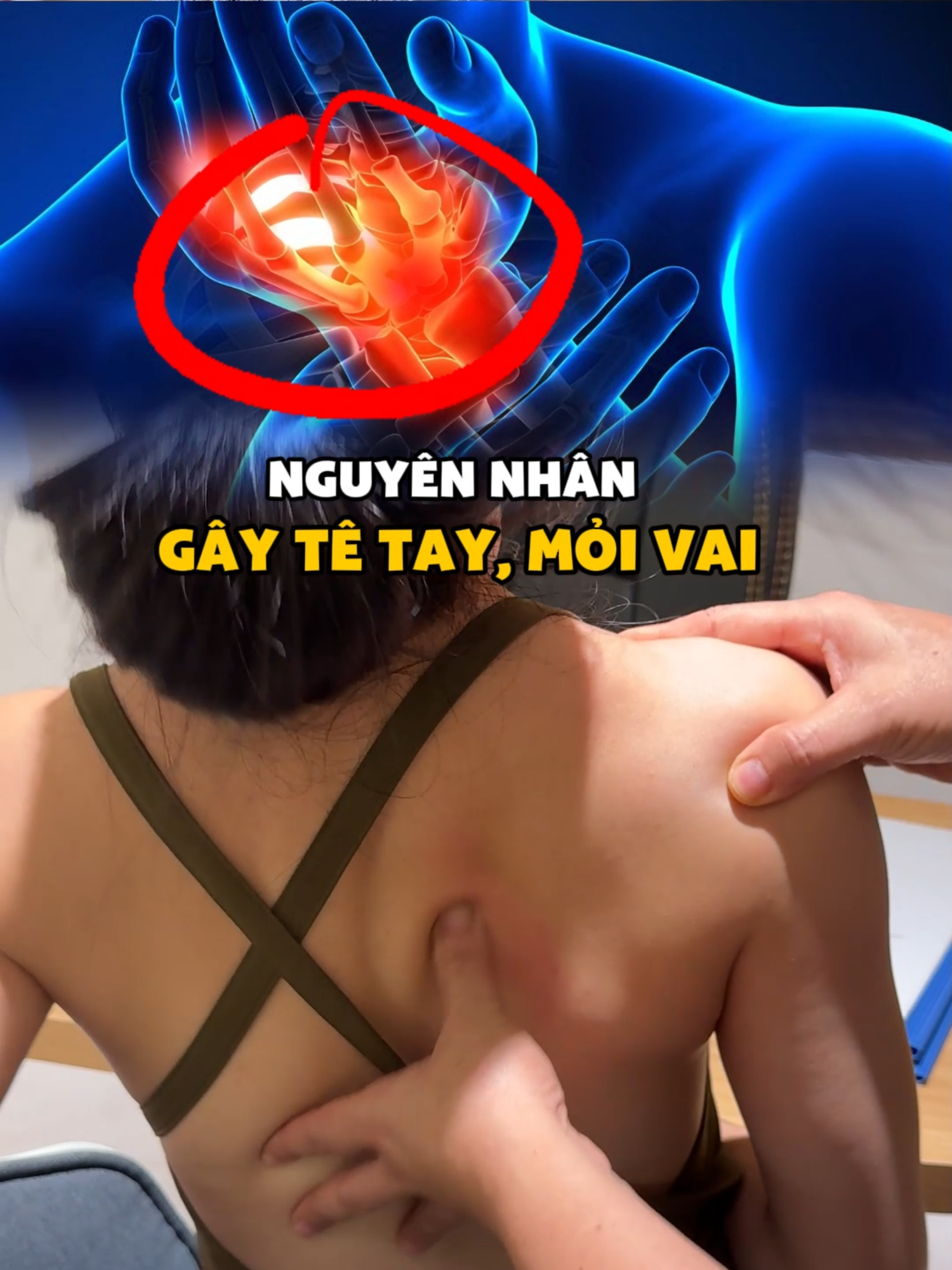 Nguyên nhân Gây tê tay, mỏi vai #vatlytrilieu #chamsocsuckhoe #viencoxuongkhopsigma #thesigma #sigmacare #xhtiktok