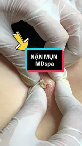 #nặn_mụn #lêthithuydung616 #chuyên_đtri_mụn_rỗ_tpvinh_nghệan #mdspa_chuyên_mụn_rỗ_tpvinh 