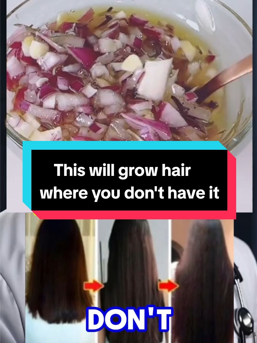 Don't use this hair treatment every day because it makes your hair long and soft in just 7 days. #naturalremedy #naturalremedies #recipes  #haircareroutine #haircare #Recipe  This will grow #hair where you don't have it. #hairloss #hairgrowth #remedy 