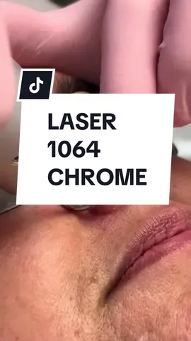 Telangiectasias ou vasinhos no nariz? O Laser Chrome, com seu comprimento de onda 1064 nm em pulso longo, é uma das tecnologias mais eficazes para tratar esses vasos aparentes. Ele atua diretamente na hemoglobina, promovendo a coagulação do vaso sem agredir a pele ao redor. Resultado? Pele mais uniforme e saudável! #LaserFacial #TratamentoDeVasos #Telangiectasias #DermatologiaEstética #Laser1064nm #SaúdeDaPele #PeleBonita #LaserParaVasos #EstéticaFacial #LaserChrome #CuidadosComAPele