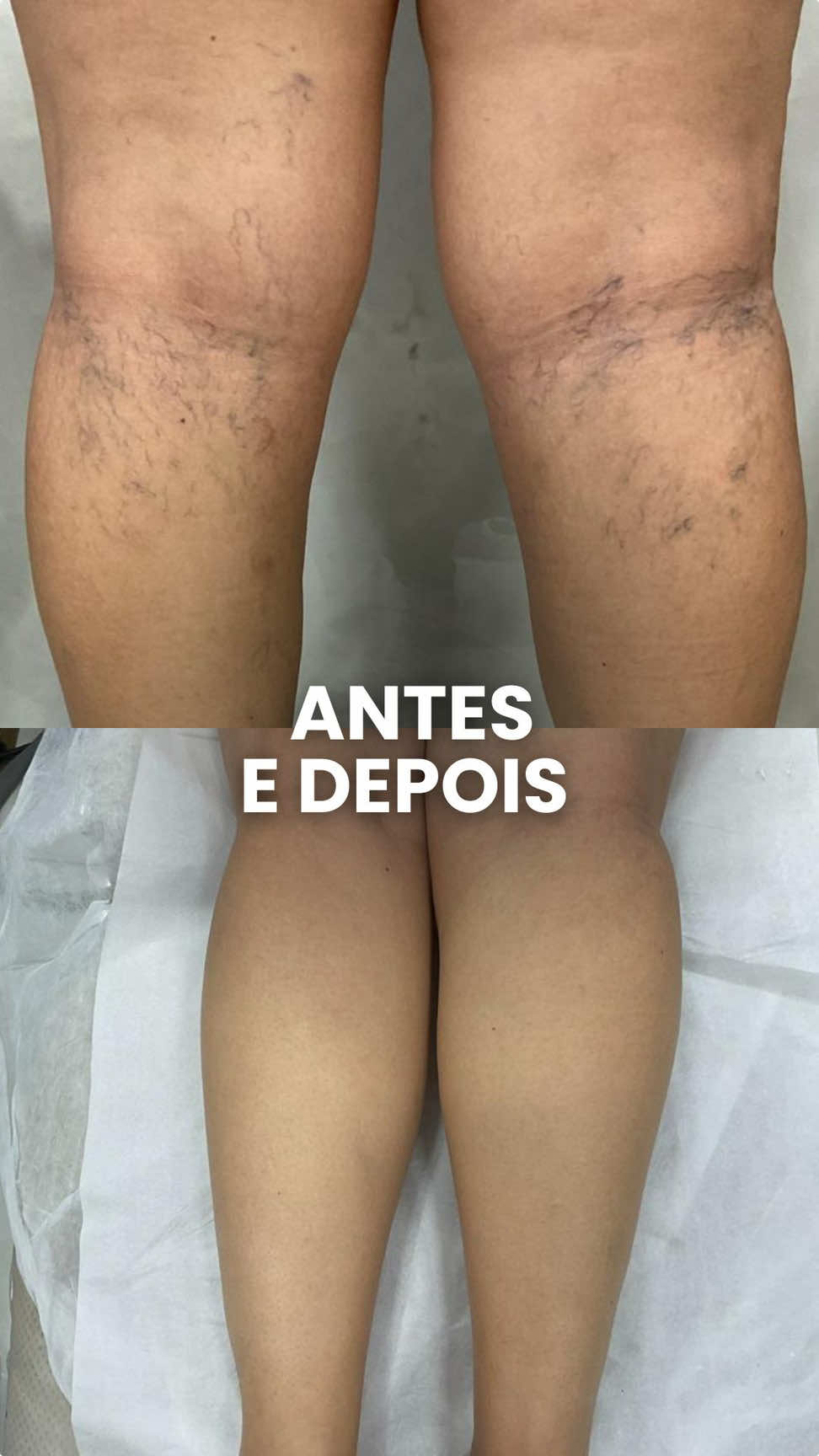 Antes e depois de respeito! 😎 #vasinhos #varizes #vascular 