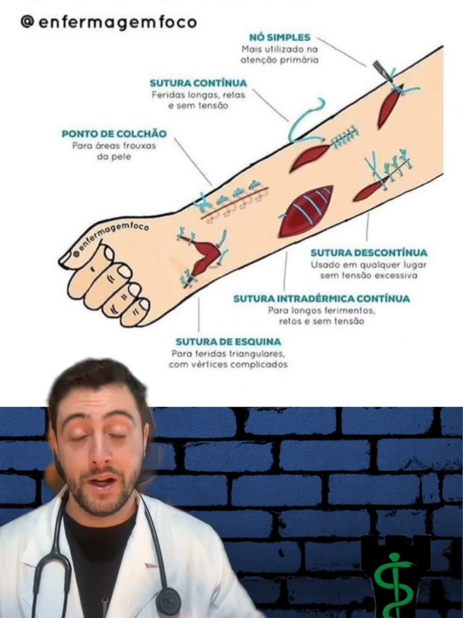 QUAL A DIFERENÇA DAS SUTURAS?#sutura #medicina #curiosidades #foryou #foryoupage #fyp #viral_video #viralvideos #viralditiktok #viraliza #viralvideotiktok #Saúde #Medicina #Enfermagem #ProfissionaisDaSaúde #CuidadosComASaúde #VidaSaudável #BemEstar #Médico #MedicinaÉVida #Doutor #Clínica #Consultório #Especialista #SaúdeÉPrioridade #Enfermeira #EnfermagemComAmor #CuidadoDeEnfermagem #EnfermeirosNaLinhaDeFrente #TécnicoDeEnfermagem #EnfermagemÉArte #AnjosDeBranco #SaúdeEPrevenção #ConhecimentoÉSaúde #CuideDeVocê #EducaçãoEmSaúde #SalvandoVidas #HéroisDaSaúde